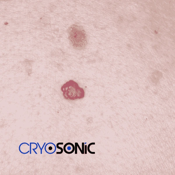 Looking for pain free cherry angioma removal treatment Bath? Call our team today! Bath
