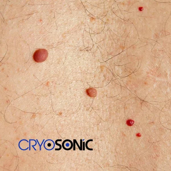 get cherry angioma removal treatment today! Bath