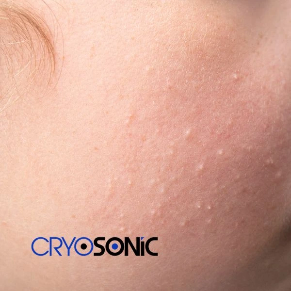 Are you looking for milia removal treatment? Contact our team today Bath
