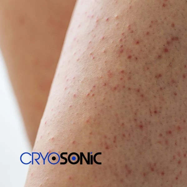 Looking for Seborrhoeic Keratosis removal Bath treatment? Call our consultants today in Bath