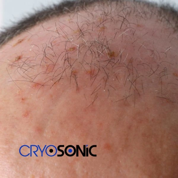 Access Seborrhoeic Keratosis removal from the comfort of your own home! Call us today in Bath