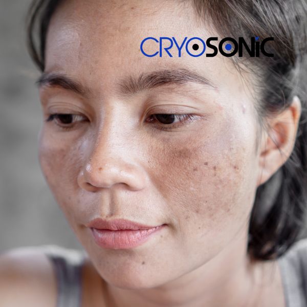 Ready to start age spots removal? Contact our team today in Bath