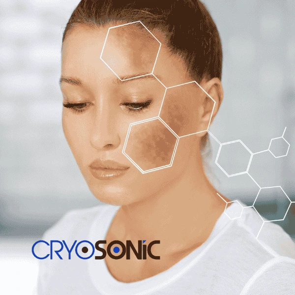 Are you looking for age spot removal treatment? Contact Cryosonic today in Bath