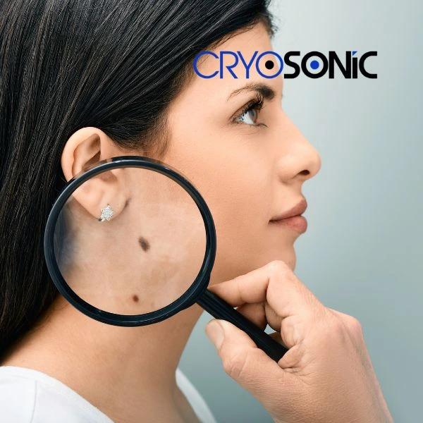 Do you want to learn more about benign moles removal treatment? Call our team today Bath