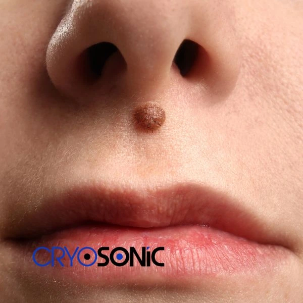 Start your benign moles removal treatment today Bath