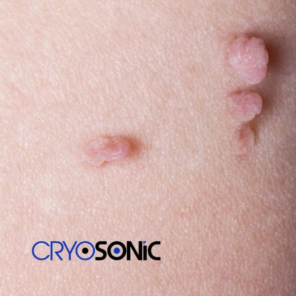Are you looking for fast effect skin tag removal Bath? Book in NOW! Bath