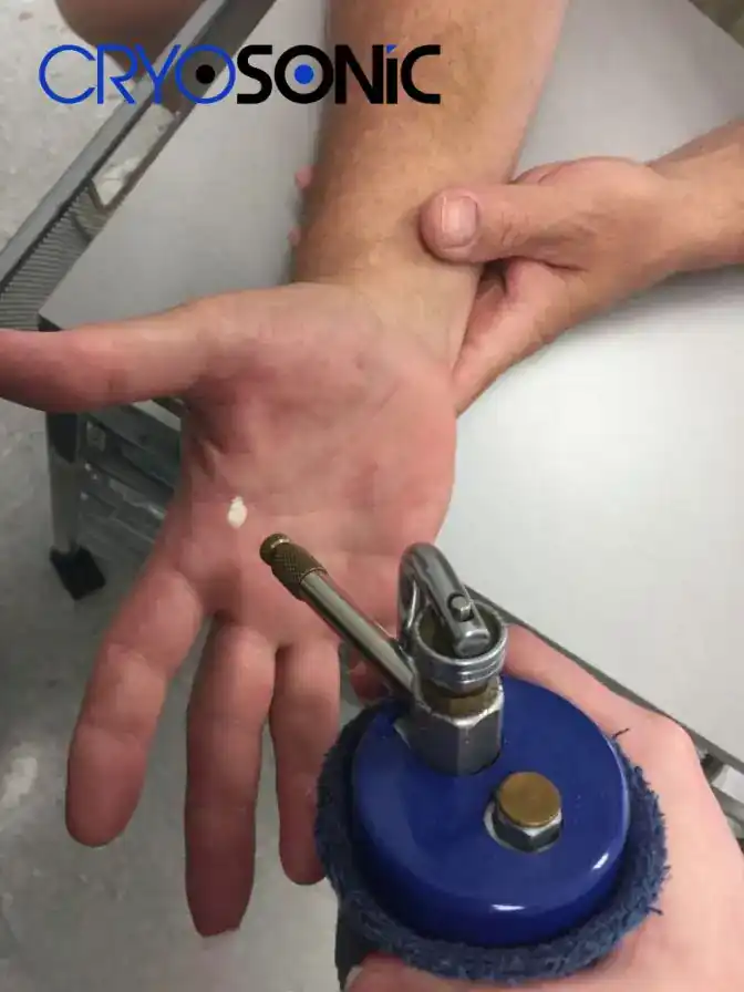 Temperature Differences: OTC vs Medical-Grade Cryotherapy Bath